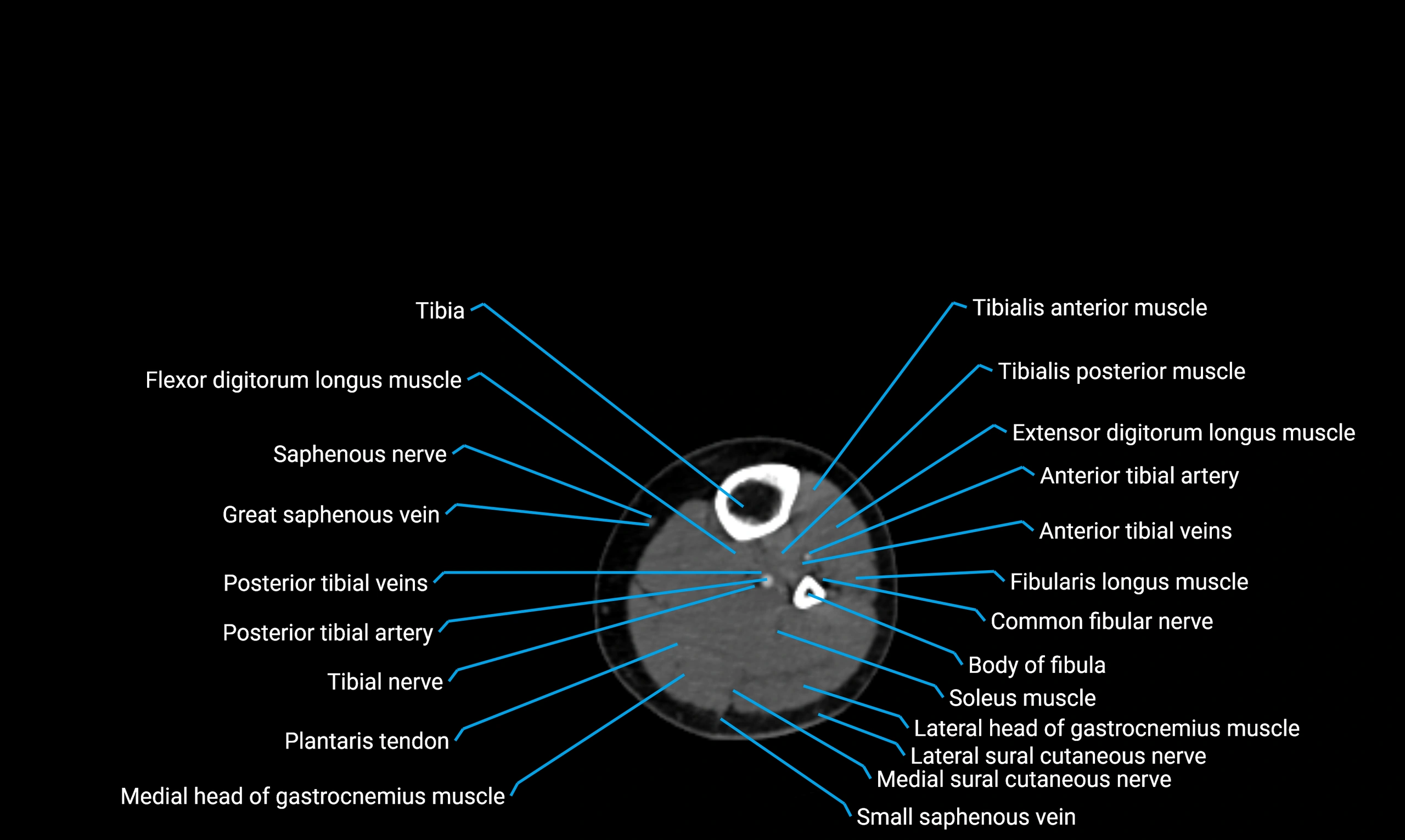 CT lower limb axial cross sectional anatomy labelled image 106 (2).webp